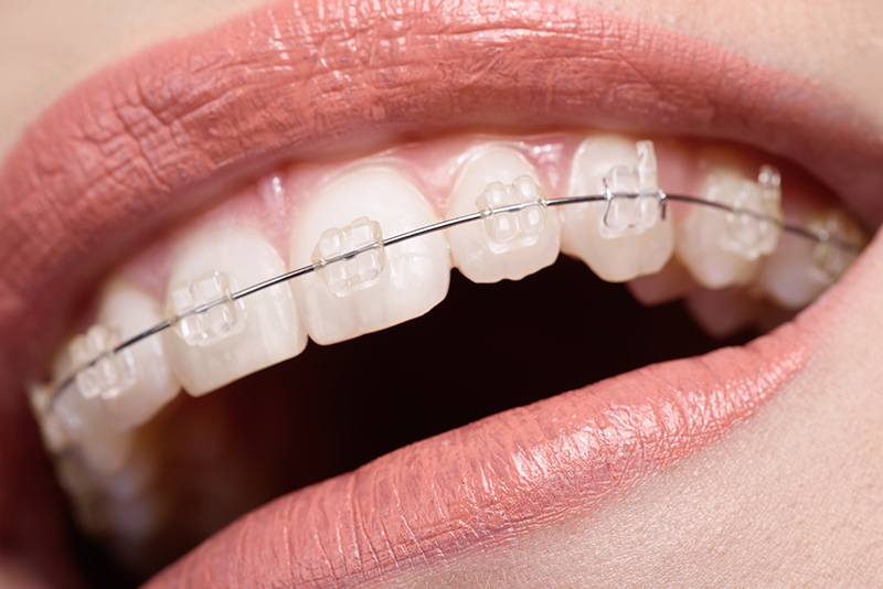 セラミック矯正と通常のワイヤー矯正の違い