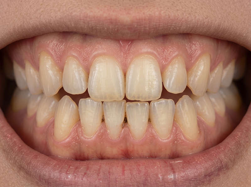 インプラントとは