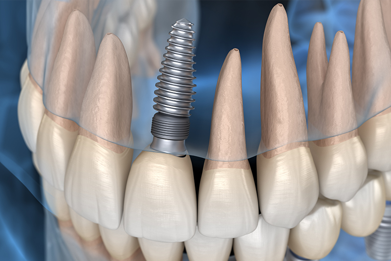ガイドシステムによる安全性の高いインプラント治療