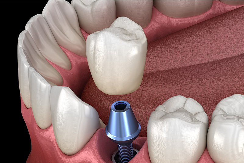 上部構造（人工歯）