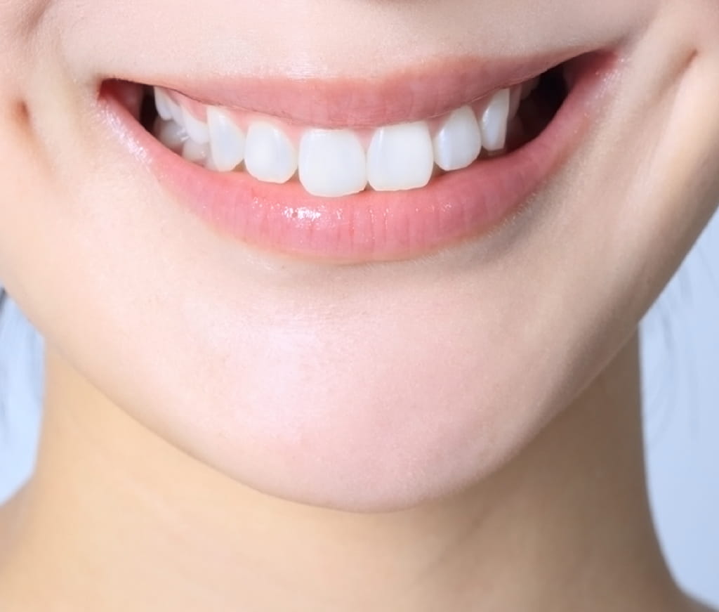 セラミック矯正